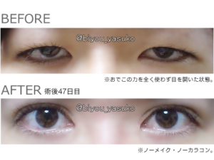 「もう二重整形ぐらいは許してやれよ」みたいな世の中なってきたな