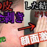 ニキビ跡のクレーターってピーリングで治るもんなんか?  レーザーがいい?