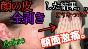 ニキビ跡のクレーターってピーリングで治るもんなんか？ 　レーザーがいい？