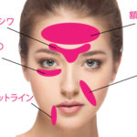 法令線へのヒアルロン酸注入かダブロか　やってみた検証スレ！